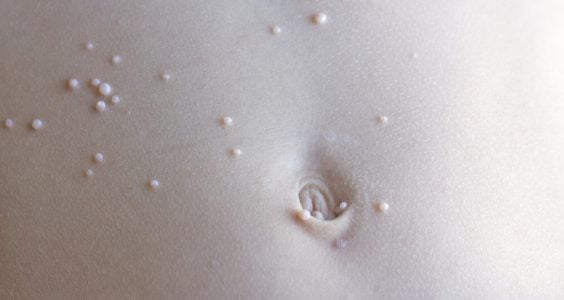 Molusky - infekčné ochorenie kože